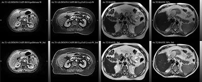 Deep learning auto-segmentation on multi-sequence magnetic resonance images for upper abdominal organs